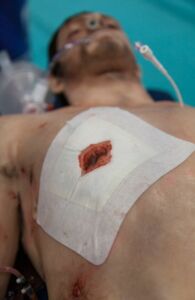 Russell Chest Seal™